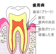 歯周病の進行